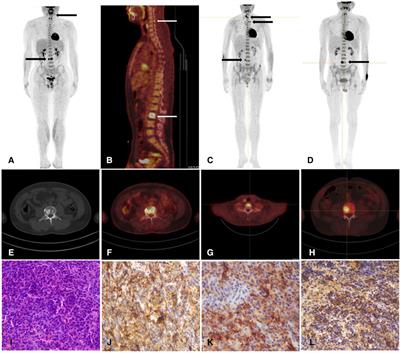 Case Report: Application of 18F-FDG PET/CT in identifying plasmacytoma in monoclonal gammopathy associated peripheral neuropathy